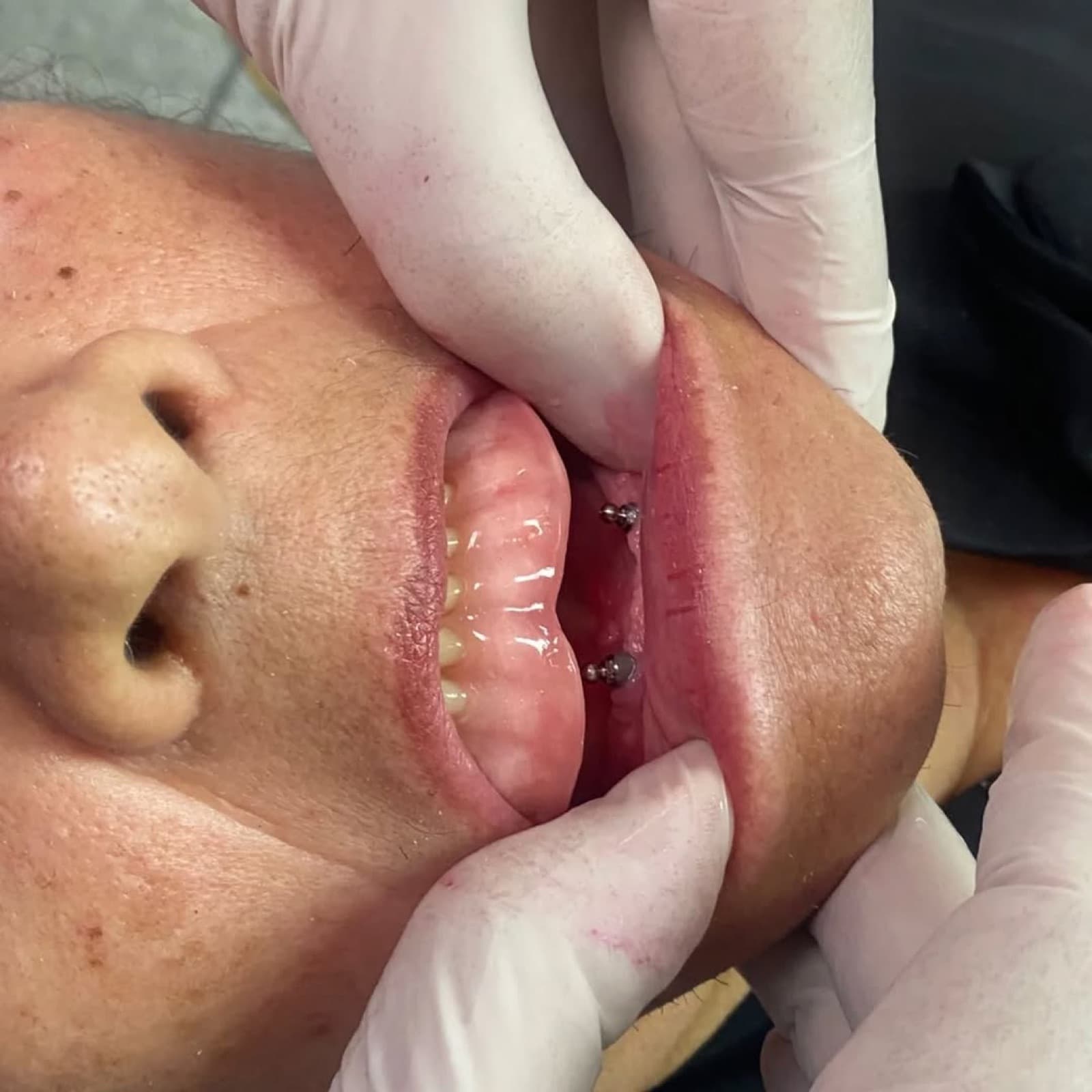 Caso clínico de implantes dentales mucosoportados en Ocaña - vista frontal
