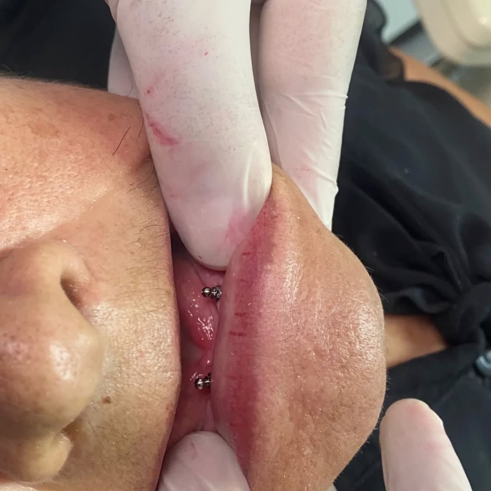 Implantes dentales sobredentadura en Ocaña - vista lateral del caso