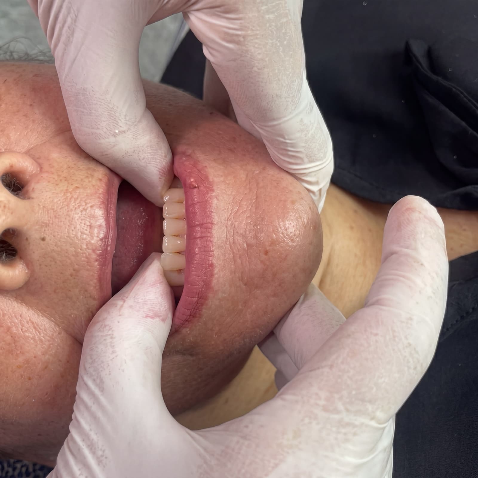 Sobredentadura sobre implantes terminada - rehabilitación oral en Ocaña