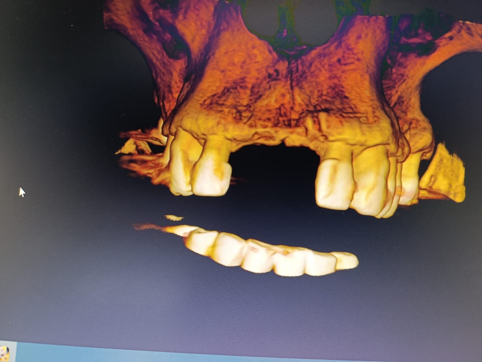 Reconstrucción 3D del maxilar superior con dientes y arcada mandibular - tomografía dental Ocaña