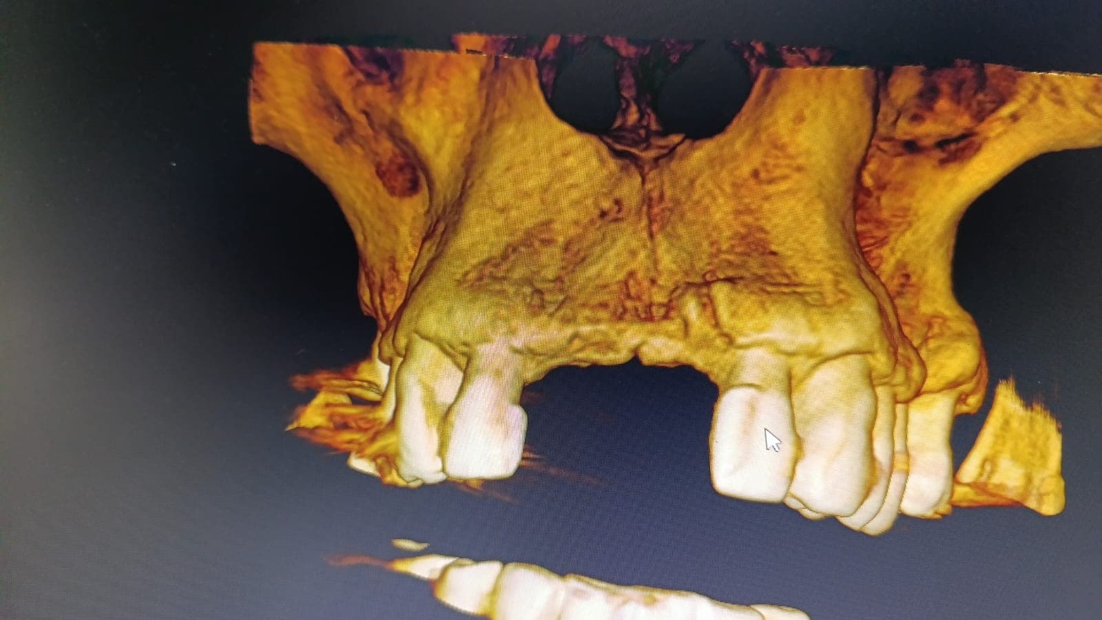 Tomografía dental 3D - vista frontal del maxilar superior con teeth y reabsorción ósea visible - Odonto Sonrie Ocaña