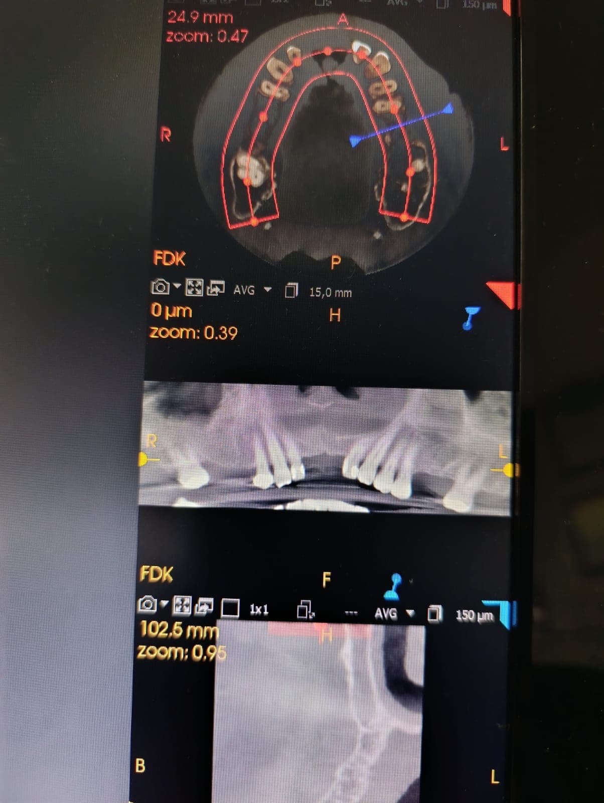 Vista multipanel CBCT con corte axial panorámico y sagital - Odonto Sonrie Ocaña